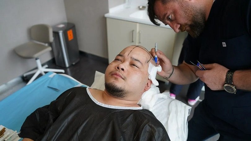 Bild zum Artikel Kosten Haartransplantation Türkei